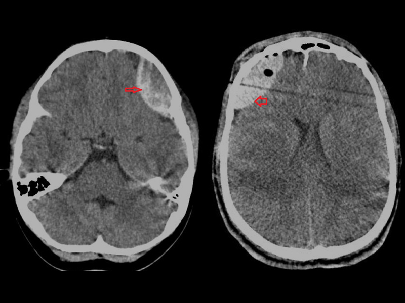 Hematoma Extradural Ou Hematoma Epidural HED Neurolink