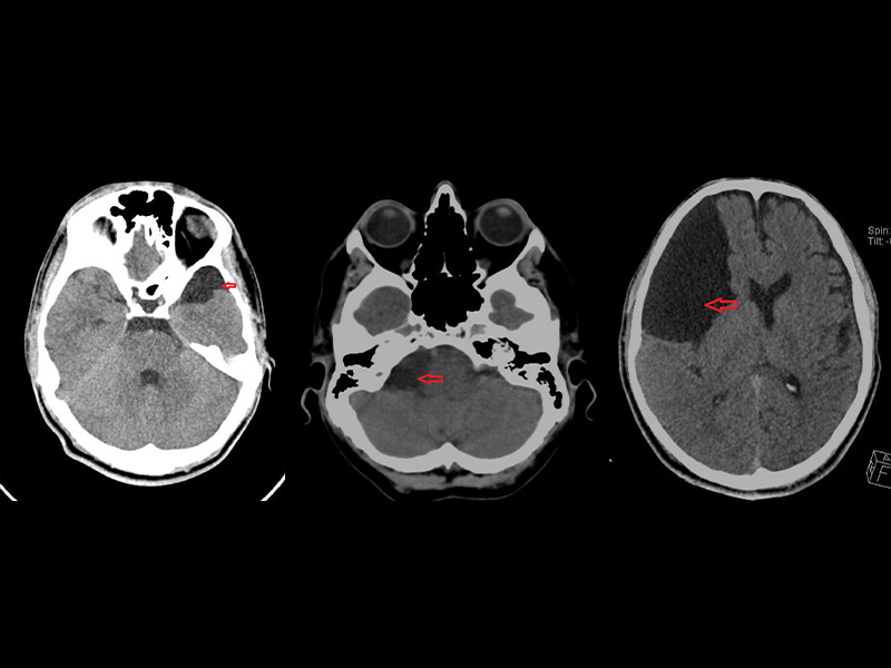 A imagem mostra, à esquerda, um corte de tomografia computadorizada de crânio com cisto aracnoide. No centro, um corte de tomografia computadorizada de crânio com cisto aracnoide. E à direita, um corte de tomografia computadorizada de crânio com volumoso cisto aracnoide.