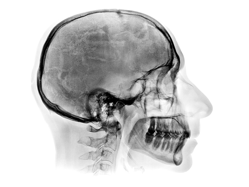 A concussão trata-se de uma alteração no estado mental, causada por um traumatismo cranioencefálico, ou seja, por um golpe na cabeça. Saiba mais!