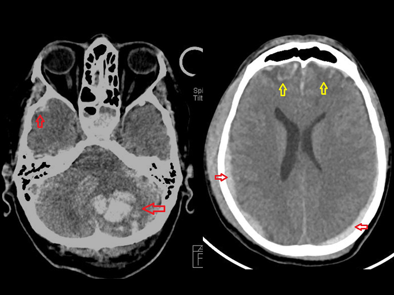 A imagem mostra, à esquerda, um corte de tomografia computadorizada de crânio com hematoma subdural agudo (setas vermelhas) e contusão cerebral (setas amarelas). E à direita, um corte de tomografia computadorizada de crânio com contusões hemorrágicas.