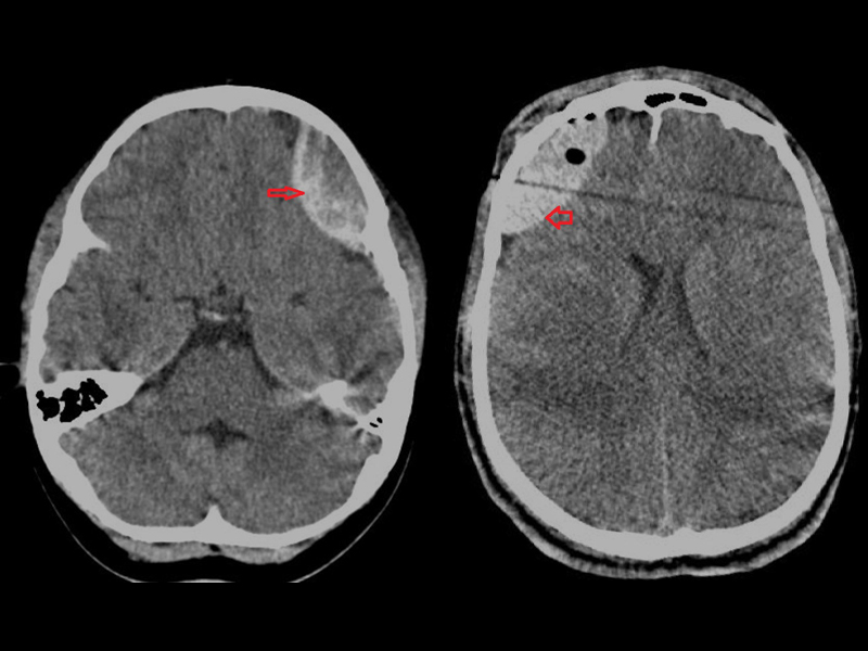 Imagem mostra, à esquerda, um corte de tomografia computadorizada de crânio com hematoma extradural, e à direita, um corte de tomografia computadorizada de crânio com hematoma extradural.