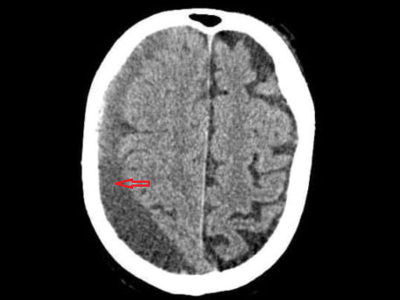 A imagem mostra um corte de tomografia computadorizada de crânio com hematoma subdural crônico.