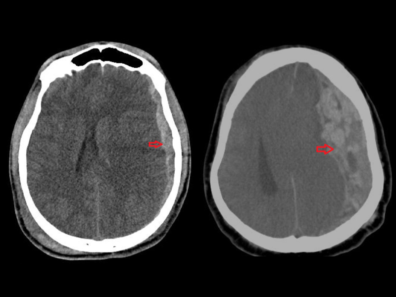 A imagem mostra, à esquerda, um corte de tomografia computadorizada de crânio com hematoma subdural agudo, e à direita, um corte de tomografia computadorizada de crânio com volumoso hematoma subdural agudo.