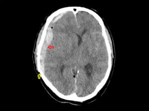 A imagem mostra um corte de tomografia computadorizada de traumatismo cranioencefálico (TCE).  O crânio apresenta hematoma subdural agudo (seta vermelha) e fratura (seta amarela).