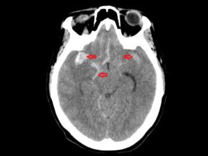 A imagem mostra um corte de tomografia de crânio com hemorragia subaracnoidea.