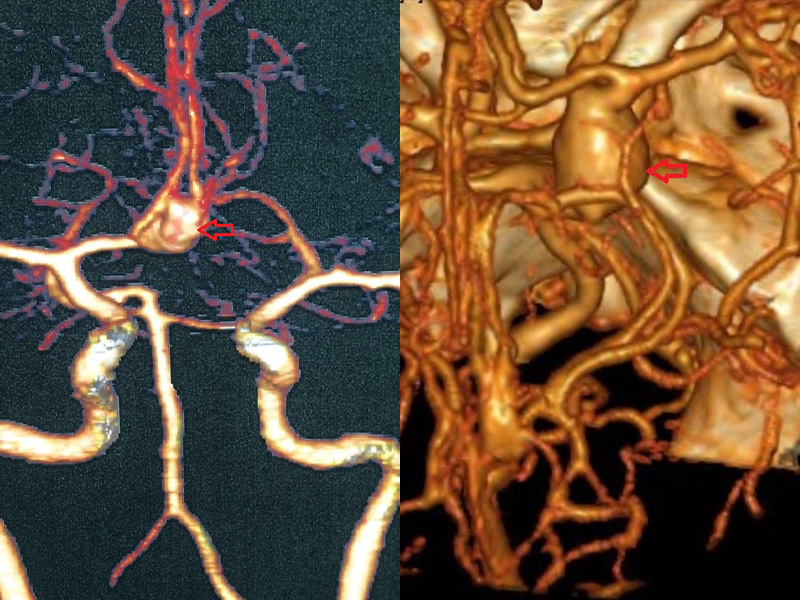 A imagem mostra, à esquerda, angioressonância de crânio com aneurisma cerebral; e à direita, angiotomografia de crânio com aneurisma cerebral.