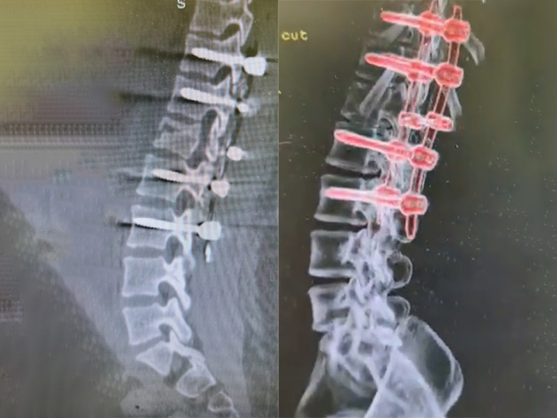 Artrodese da Coluna Vertebral 