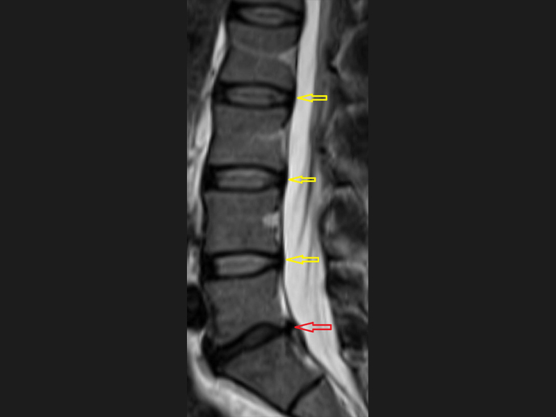 A imagem mostra uma ressonância magnética de coluna lombossacra com discos normais (setas amarelas) e discos com discopatia degenerativa (seta vermelha).