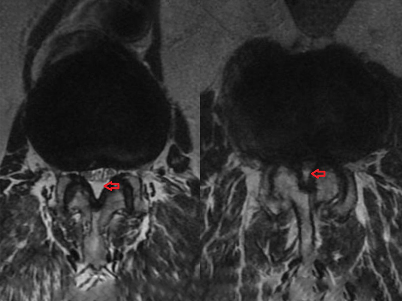 A imagem mostra, à esquerda, ressonância magnética da coluna lombossacra evidenciando estenose leve do canal vertebral; e à direita, ressonância magnética da coluna lombossacra evidenciando estenose severa do canal vertebral.