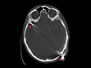 A imagem mostra um corte de tomografia computadorizada de crânio com ferimento por arma de fogo, evidenciando fratura óssea e presença de fragmentos ósseos e metálicos intracranianos