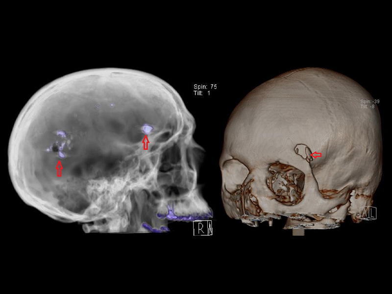 A imagem mostra, à esquerda, radiografia de crânio evidenciando ferimento por arma de fogo, com projétil intracraniano; à direita, reconstrução de tomografia de crânio evidenciando fratura óssea relacionada a ferimento por arma de fogo.