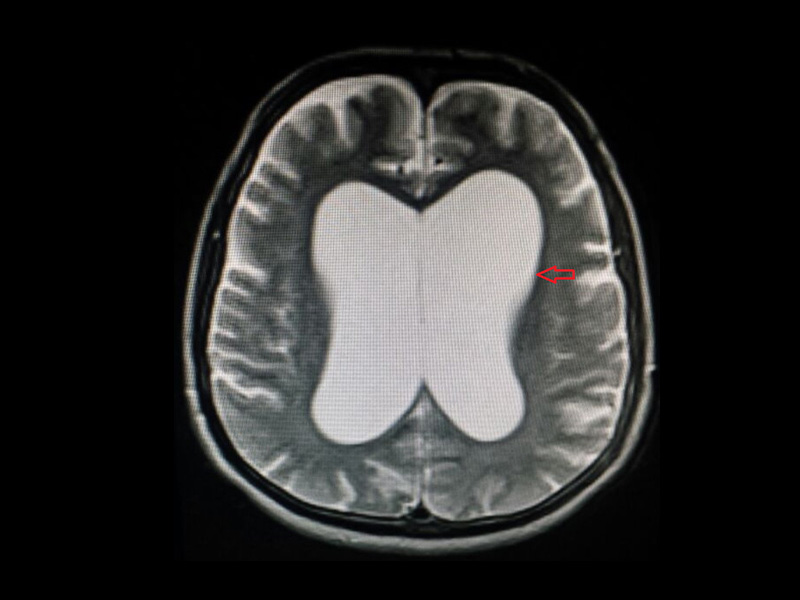 A imagem exibe um corte de ressonância magnética de crânio com hidrocefalia de pressão normal. 
