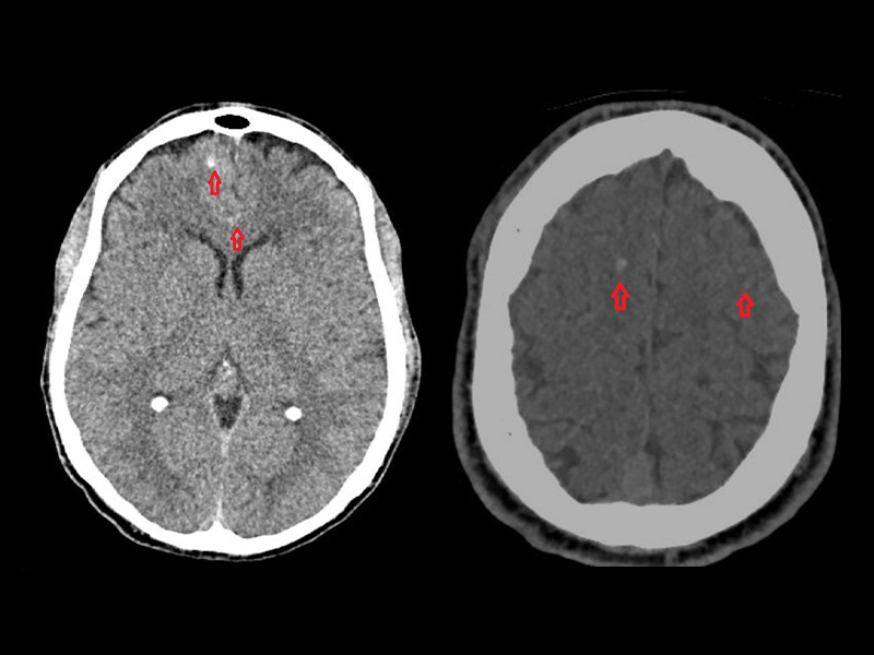 Imagem mostra, à esquerda, corte de tomografia computadorizada de crânio com lesão axonal difusa; e à direita, corte de tomografia computadorizada de crânio com lesão axonal difusa.