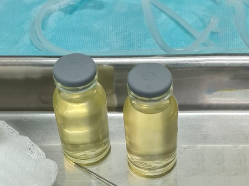 Imagem do liquor alterado em paciente com meningite - o liquor normal deve ser límpido como a água.