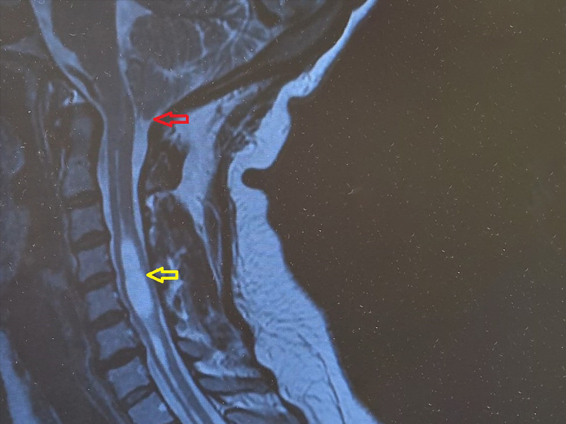 A imagem mostra um corte de ressonância magnética evidenciando deslocamento inferior do cerebelo (seta vermelha) – característico da Síndrome de Arnold-Chiari – e hidrossiringomielia (seta amarela).