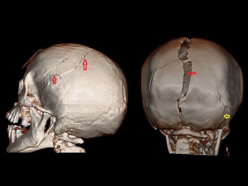 A imagem mostra um traumatismo cranioencefálico (TCE). À esquerda, reconstrução de tomografia de crânio evidenciando fraturas; e à direita, reconstrução de tomografia de crânio evidenciando diástase de suturas cranianas (seta vermelha) e traço de fratura (seta amarela).