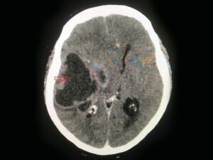 A imagem mostra um corte de tomografia computadorizada de crânio com tumor cerebral.