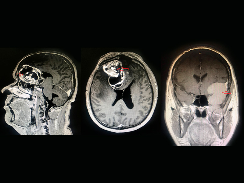 : A imagem exibe, lado a lado, três cortes de ressonância magnética de crânio com tumor cerebral.