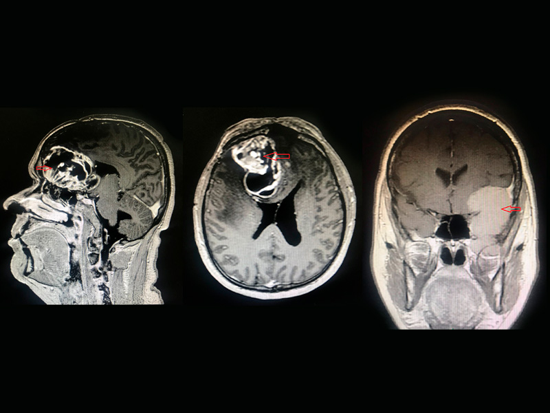 Tumor Cerebral Neurolink Porto Alegre 1978